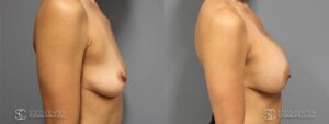 Breast Augmentation Before and After Photos - Patient 10C