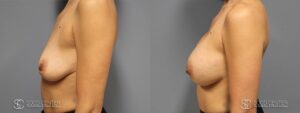 Breast Augmentation Before and After Photos - Patient 10B