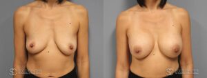 Breast Augmentation Before and After Photos - Patient 10A