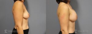 Breast Augmentation Before and After Photos - Patient 11B