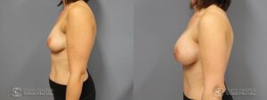Breast Augmentation Before and After Photos - Patient 11C