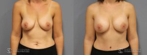 Breast Augmentation Before and After Photos - Patient 11A