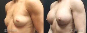 Breast Augmentation Before and After Photos - Patient 1C