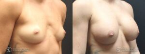 Breast Augmentation Before and After Photos - Patient 1B
