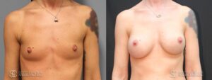 Breast Augmentation Before and After Photos - Patient 3A