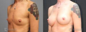 Breast Augmentation Before and After Photos - Patient 3C