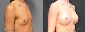 Breast Augmentation Before and After Photos - Patient 3B