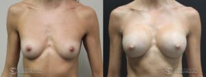 Breast Augmentation Before and After Photos - Patient 5A