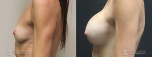 Breast Augmentation Before and After Photos - Patient 5C