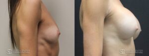 Breast Augmentation Before and After Photos - Patient 5B
