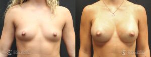 Breast Augmentation Before and After Photos - Patient 6A