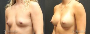 Breast Augmentation Before and After Photos - Patient 6B