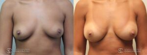 Breast Augmentation Before and After Photos - Patient 7A