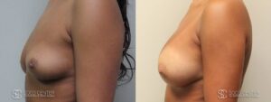 Breast Augmentation Before and After Photos - Patient 7B