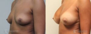 Breast Augmentation Before and After Photos - Patient 7C