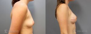 Breast Reconstruction Before and After Photos - Patient 5B