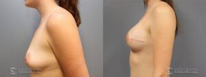 Breast Reconstruction Before and After Photos - Patient 5C