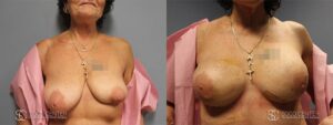 Breast Reconstruction Before and After Photos - Patient 6A
