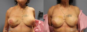 Breast Reconstruction Before and After Photos - Patient 6B