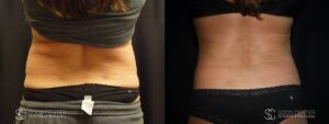 Coolsculpting Before and After Photos - Patient 10A