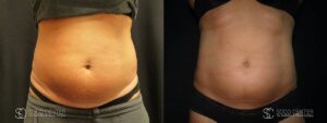 Coolsculpting Before and After Photos - Patient 10B