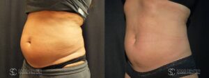 Coolsculpting Before and After Photos - Patient 10C