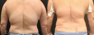 Coolsculpting Before and After Photos - Patient 11A