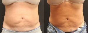 Coolsculpting Before and After Photos - Patient 11B