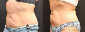 Coolsculpting Before and After Photos - Patient 12A