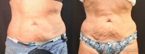 Coolsculpting Before and After Photos - Patient 12B
