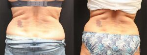 Coolsculpting Before and After Photos - Patient 12C