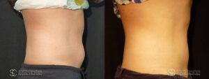 Coolsculpting Before and After Photos - Patient 13A