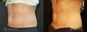 Coolsculpting Before and After Photos - Patient 13B