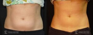 Coolsculpting Before and After Photos - Patient 13C