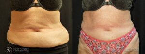 Coolsculpting Before and After Photos - Patient 14A