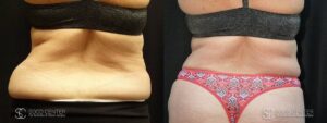 Coolsculpting Before and After Photos - Patient 14B