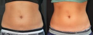 Coolsculpting Before and After Photos - Patient 16A