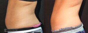 Coolsculpting Before and After Photos - Patient 16B