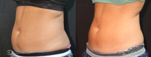 Coolsculpting Before and After Photos - Patient 16C