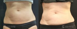 Coolsculpting Before and After Photos - Patient 17A