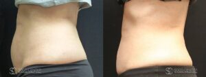 Coolsculpting Before and After Photos - Patient 17B