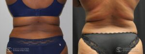 Coolsculpting Before and After Photos - Patient 18A