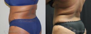 Coolsculpting Before and After Photos - Patient 18B