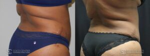 Coolsculpting Before and After Photos - Patient 18C