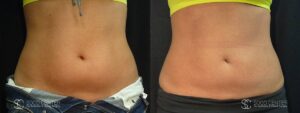 Coolsculpting Before and After Photos - Patient 19A