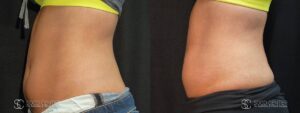 Coolsculpting Before and After Photos - Patient 19B