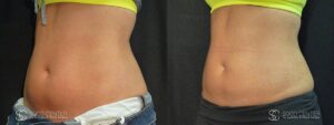 Coolsculpting Before and After Photos - Patient 19C