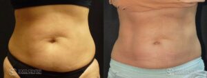 Coolsculpting Before and After Photos - Patient 20A