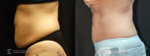 Coolsculpting Before and After Photos - Patient 20B