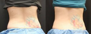 Coolsculpting Before and After Photos - Patient 21A